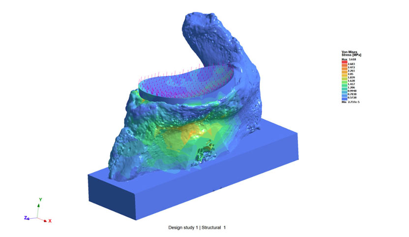 Stresses on scapula bone with glenoid implant shown