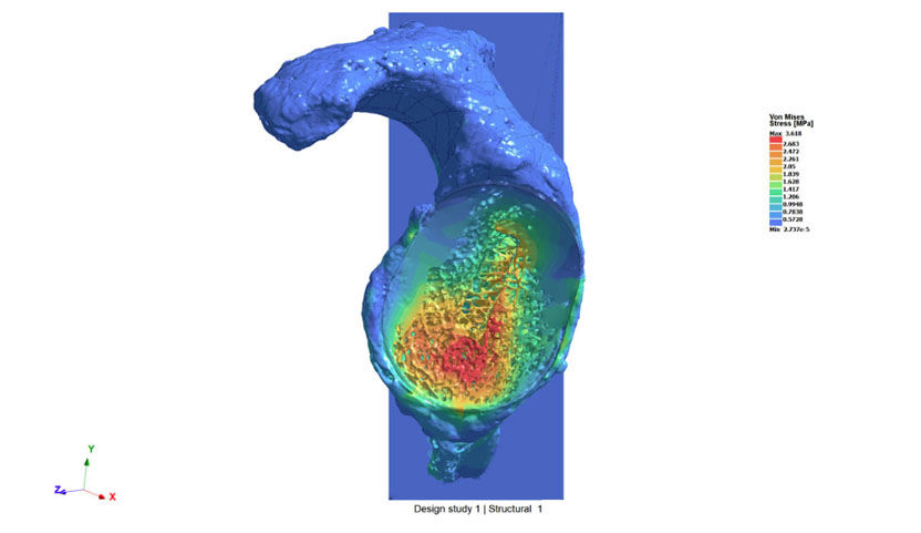 Stresses on scapula bone with glenoid implant hidden