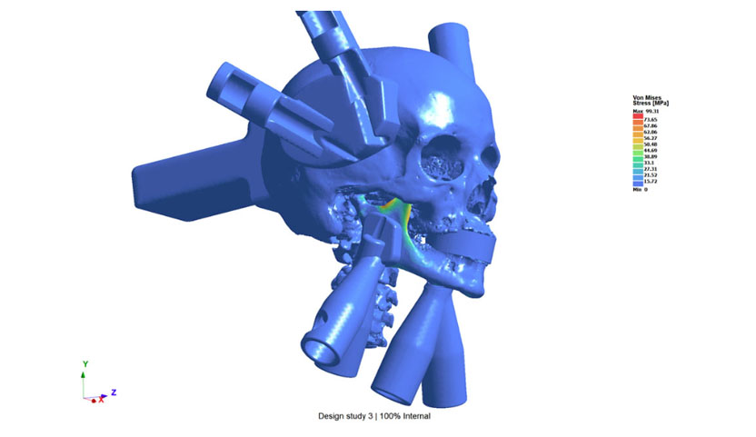 Skull and jaw bone with 3D printed piston mounts